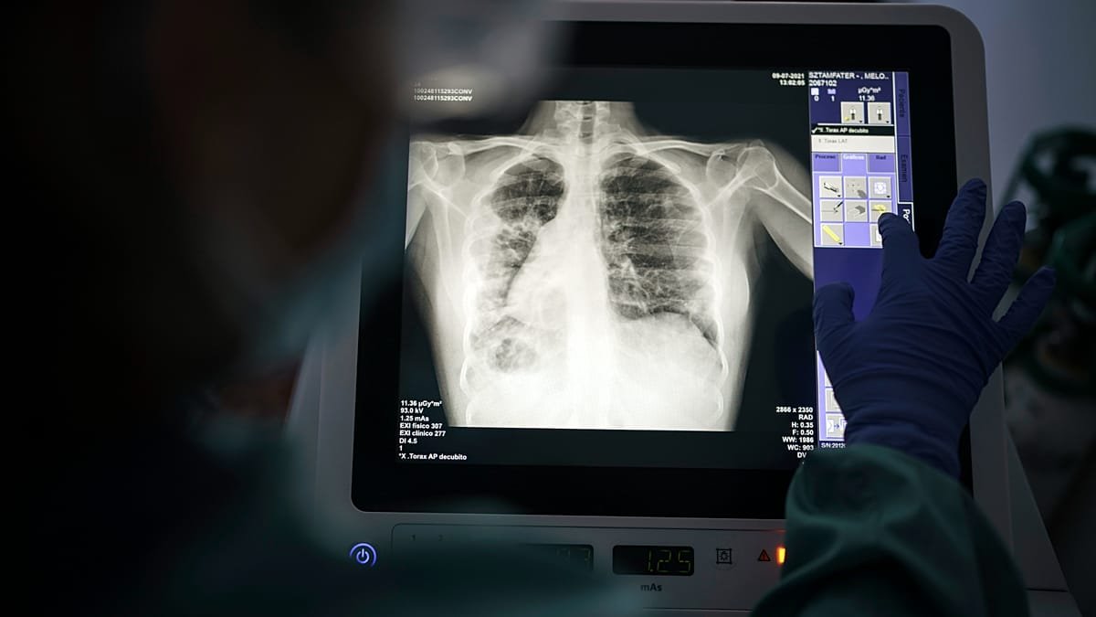 Küresel Tüberküloz Günü: Avrupa'daki Her 5 Vakalık 1'i Görülmüyor