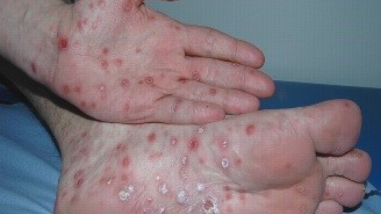 Ebola Virüsü Nedir? Belirtileri, Bulaşma Yolları Ve Korunma Yöntemleri
