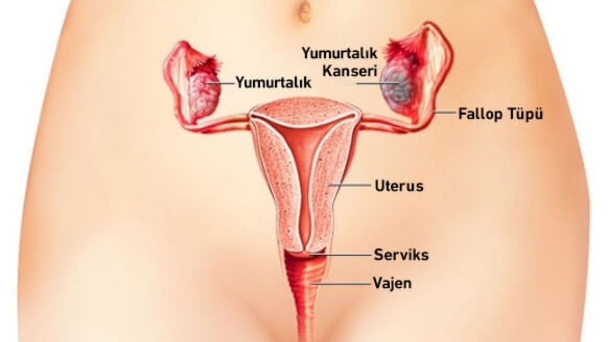Yumurtalık (Over) Kanseri: Belirtiler, Riskler ve Tedavi Yöntemleri