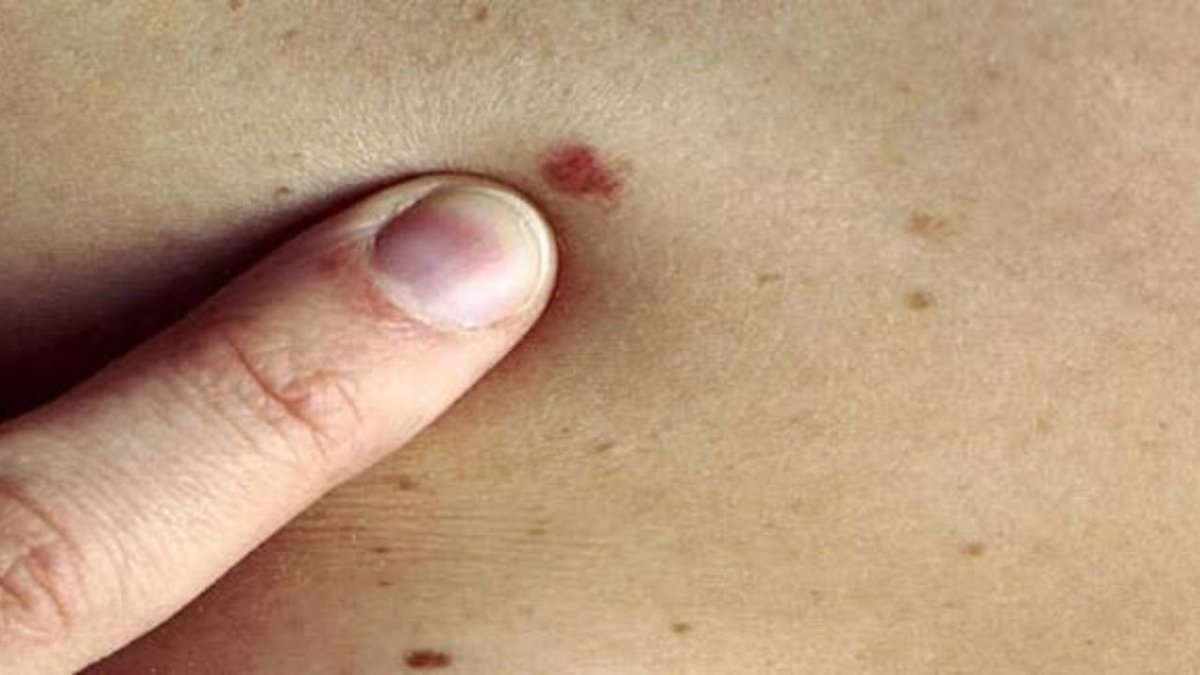 Cilt Kanseri Nedir: Belirtileri Ve Korunma Yolları