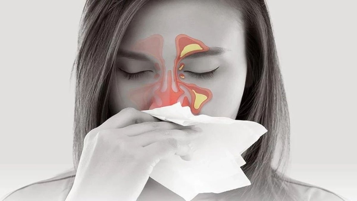 Burun Tıkanıklığı 10 Günü Geçiyorsa Dikkat: Sinüzit Riski Artıyor